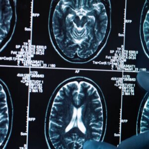 There Are 2 New Dementia Risk Factors You Should Know About